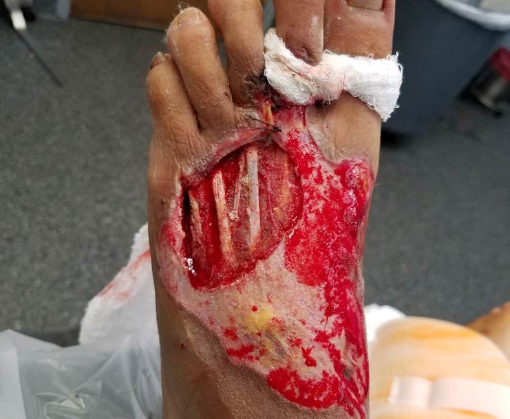 Example of an Acute Wound