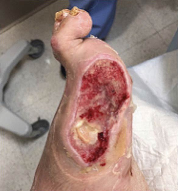 Example of a Diabetic Foot Ulcer