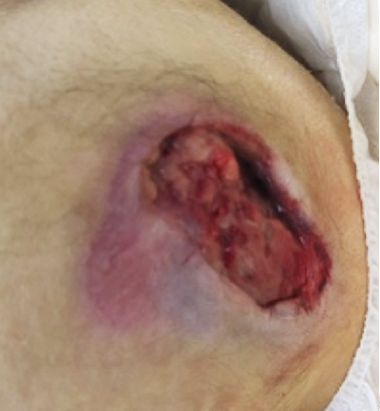 Example of a Pressure Injury