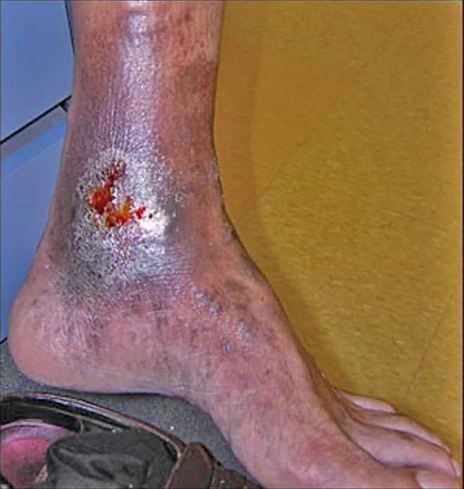 Example of a Venous Leg Ulcer