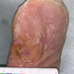 VENOUS LEG ULCER (VLU) Randomized Controlled Clinical Trial After